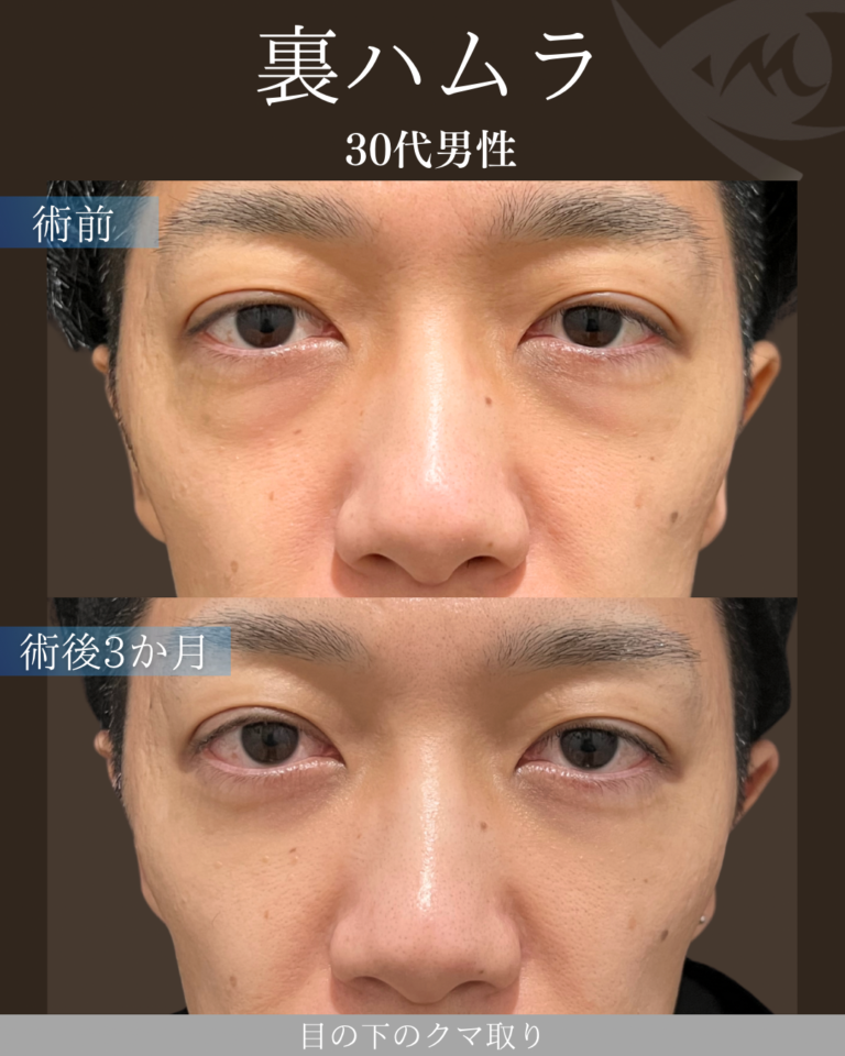 30代男性 裏ハムラ 術後3ヶ月